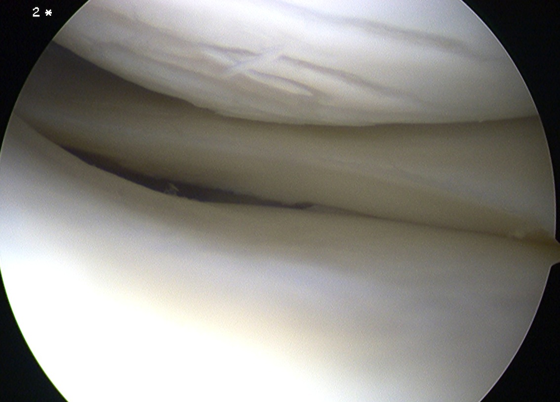 Grade 1 Chondral Lesion Femur